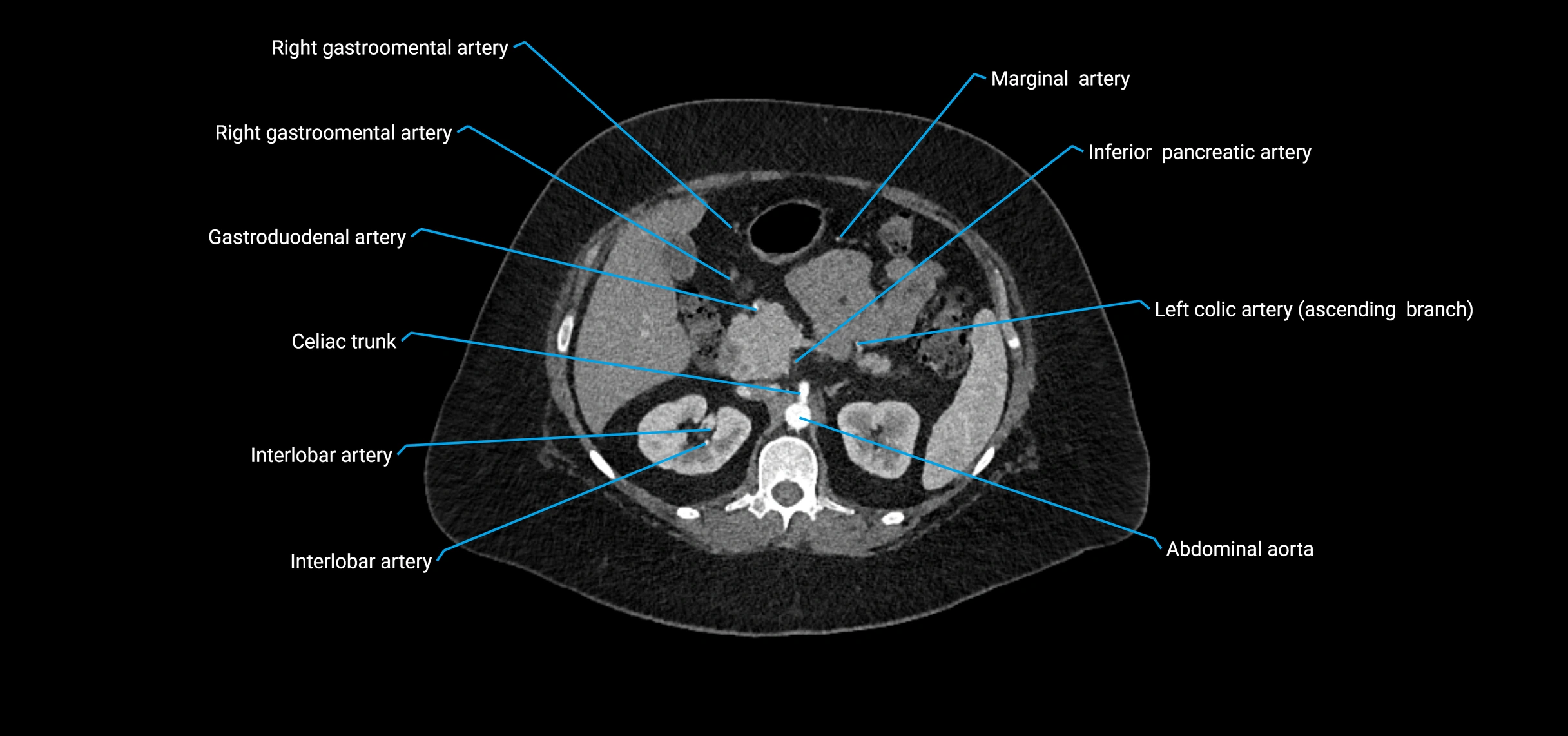 CTA abdomen axial cross sectional anatomy labelled image_62 (2).webp